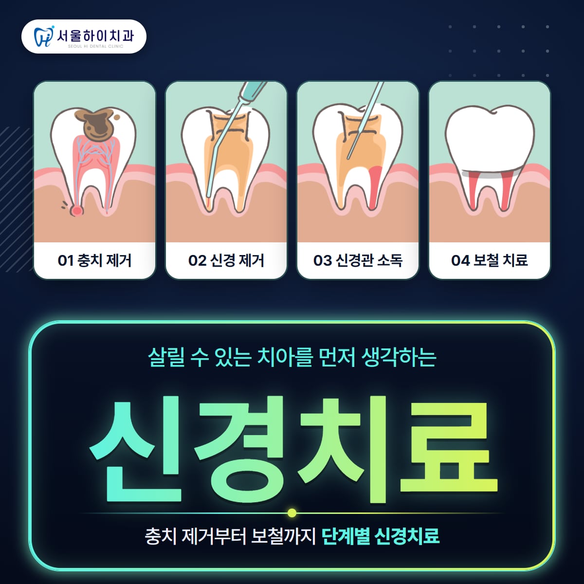 판교치과 신경치료 – 충치 제거부터 보철까지 4단계 신경치료 과정 그림